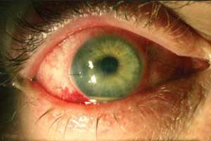 No role of Prophylactic antibiotics in endophthalmitis prevention after Intravitreal Injection