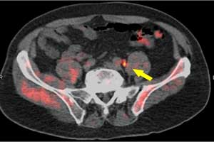 Fluciclovine PET/CT, for better management of prostate cancer : LOCATE Trial