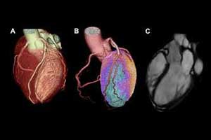 Cardiac hybrid imaging an excellent predictor for heart attack