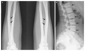 A Case of Skeletal Fluorosis Due to Excessive Tea Drinking