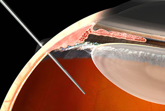 2018 Consensus Recommendations for Intravitreal Injections: Check it out