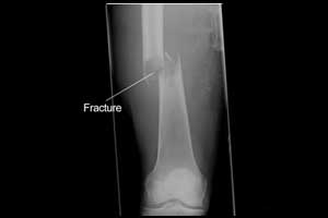 long bone fracture