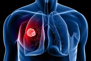 Some BP drugs increase risk of lung cancer: BMJ