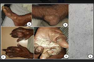 A rare case of Hyperuricemia presenting  with white powder oozing from body