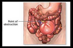 New Bologna guidelines for adhesive small bowel obstruction (ASBO)