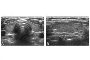 Real-time sonography differentiates diffuse thyroid disease from normal thyroid parenchyma