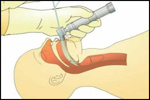 Obesity associated with difficult intubation management by laryngoscopy: BMC