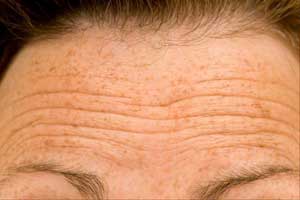 Deep forehead wrinkles harbinger of cardiovascular mortality-ESC Update