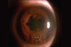 Better Diabetes control reduces risk of Uveitis in diabetics