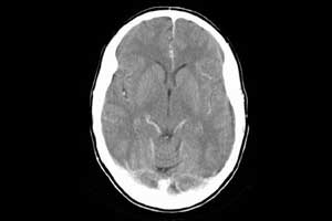 Temporal subtraction images CT images improve detection of new brain infarcts on CT-Radio