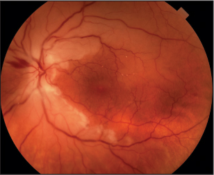 Central retinal artery occlusion patients at increased Stroke risk