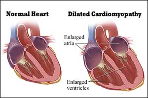 Anakinra leads to rapid clinical improvement in dilated cardiomyopathy