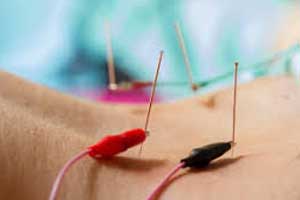 Electroacupuncture benefits patients with diabetic peripheral neuropathy