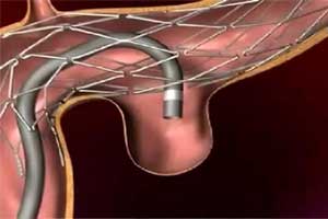 Endovascular coiling has better outcome than neurosurgical clipping in subarachnoid hemorrhage