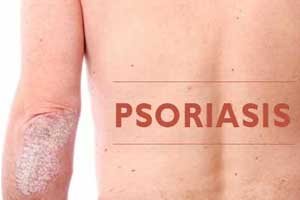 Treatment with Infliximab increases infection risk in Psoriasis patients