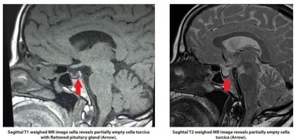 Indian doctors report an unusual case of Sheehan’s syndrome