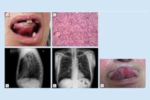 A rare case of TB Oral Cavity presenting as Painless Ulcer tongue
