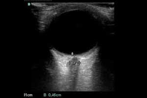 Ocular Ultrasound an effective non-invasive estimator of intracranial pressure