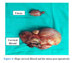 Ganga Ram Hospital gynecologists remove Giant Cervical Fibroid equivalent to size of 9 months fetus