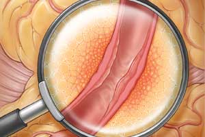 Novel imaging biomarker That predicts cardiac mortality: ESC 2018