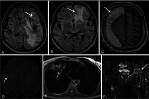 Incidental imaging findings in breast lead to highest malignancy detection