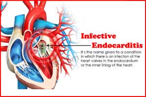 Switching to oral antibiotics halves hospital stay in endocarditis : ESC Update