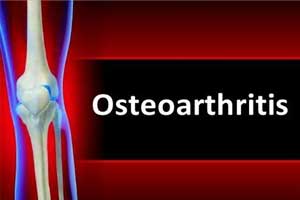 Use opioids cautiously for short duration in osteoarthritis