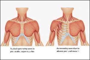 Computer-aided silicone  Implants effective in patients of Poland syndrome