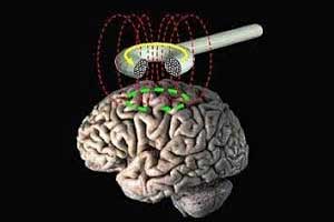 Non invasive deep magnet stimulation may improve symptoms of obsessive compulsive disorder