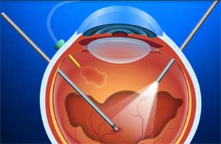 How Necessary Are Subconjunctival Antibiotics Following Pars Plana Vitrectomy?