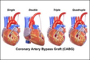 Double artery grafts better than single in CABG: ESC 2018
