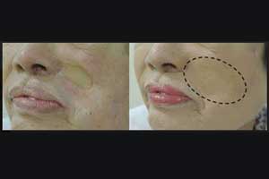 New Cosmetic product fills visible facial scars