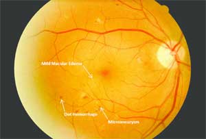 Fluocinolone insert improves Diabetic Macular Edema after Vitrectomy