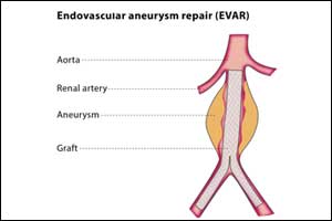 Endovascular aortic repair better than open repair for ruptured abdominal aortic aneurysms