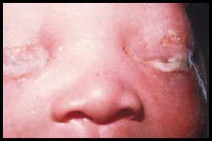 All newborns should receive Ocular Prophylaxis,reaffirms USPSTF