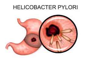 Treatment of H. pylori Infection : American College of Gastroenterology Guideline