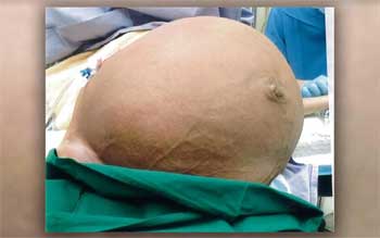 Doctors remove 28 kg Giant Fibroid from womans Uterus