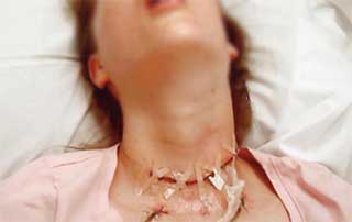A case of severe Dystonic Reaction after oral Metoclopramide