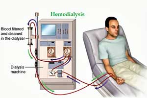 More than half of elderly CKD patients die within a year of beginning dialysis: JAMA