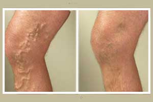 Taller you are more are chances of developing Varicose veins