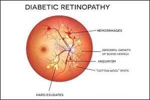 Amodiaquine finds new role in retinopathy and  macular degeneration