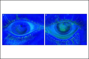 Case of Corneal ectasia following cataract extraction surgery in patient with keratoconus: a report