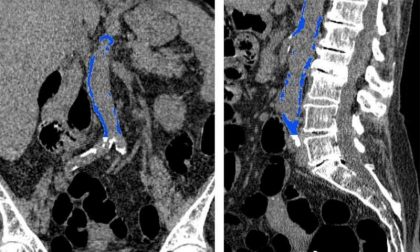 Calcification of Abdominal aorta a strong predictor of heart attack