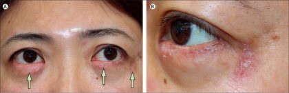 Case of persistent swollen eyelids for 3 years - Lancet