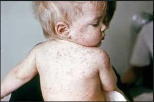 Vaccine protects against serious complication of Measles