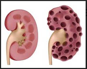 Investigational oral drug being tested for Polycystic Kidney Disease