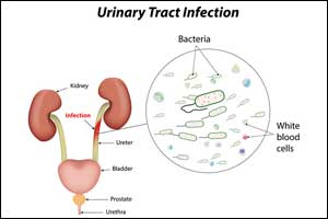 New Sensor detects hidden urinary tract infection