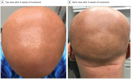 Eczema drug restores hair growth in longstanding alopecia