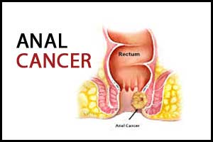 New treatment approach for advanced anal cancer