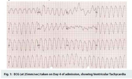 Rare case of Ventricular Tachycardia due to Dengue Fever